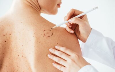 Vaccino per il melanoma: svolta nella cura