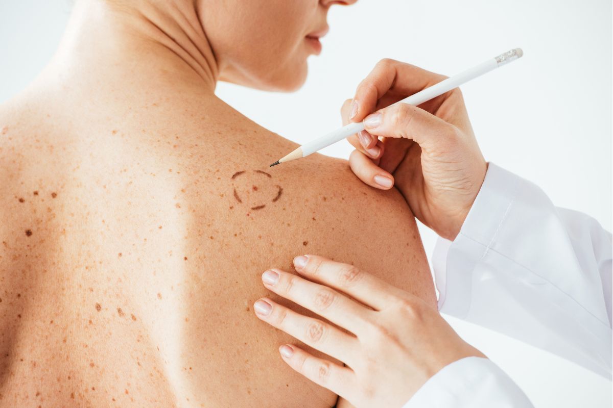 vaccino per melanoma