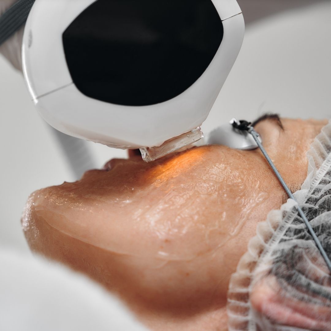 laser cicatrice tumore pelle