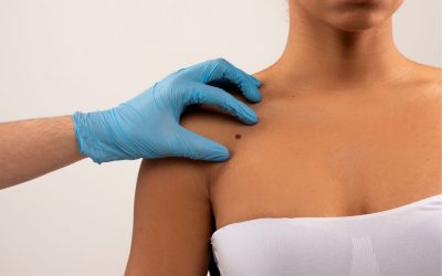 Chirurgia Mohs, rimuove i tumori cutanei con mini cicatrici