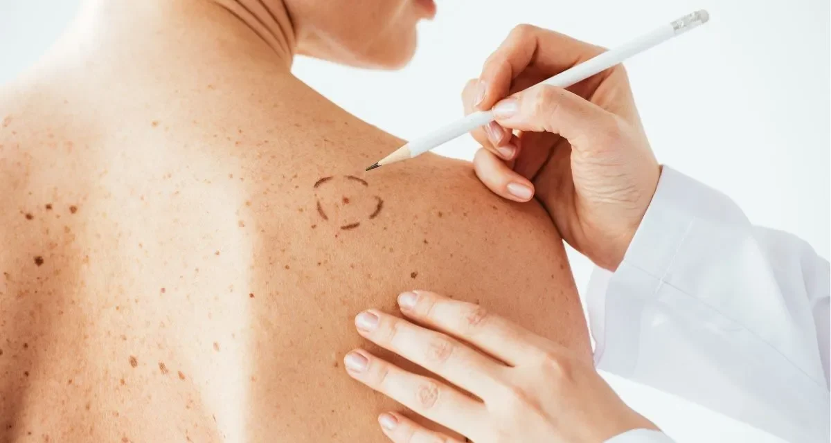 Vaccino contro il melanoma: svolta nella cura
